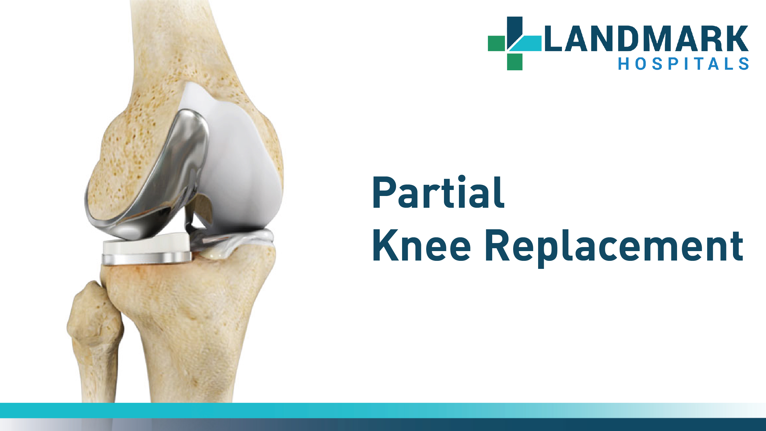 Partial Knee Replacement in Hyderabad By Dr. Sudhir Kumar Reddy
