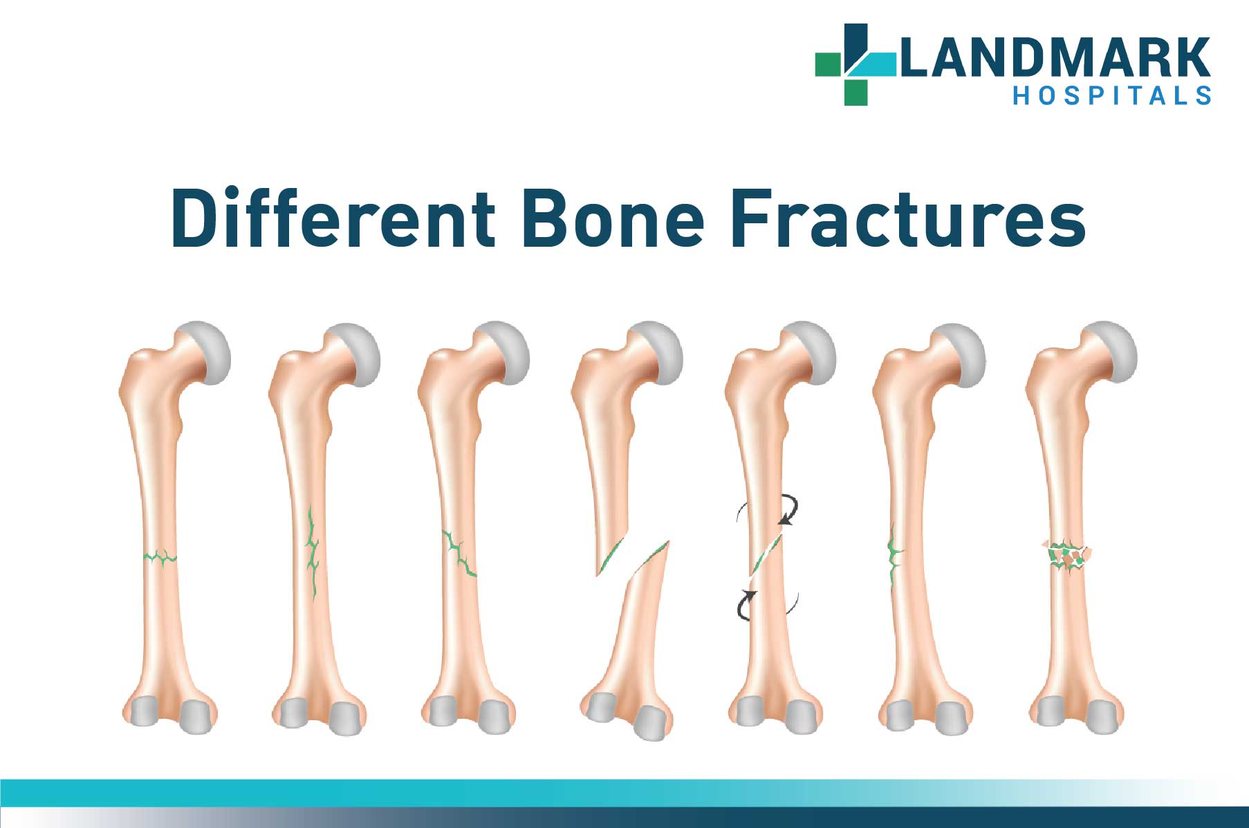 Different Bone Fractures - Orthopedic Care in Hyderabad - Landmark