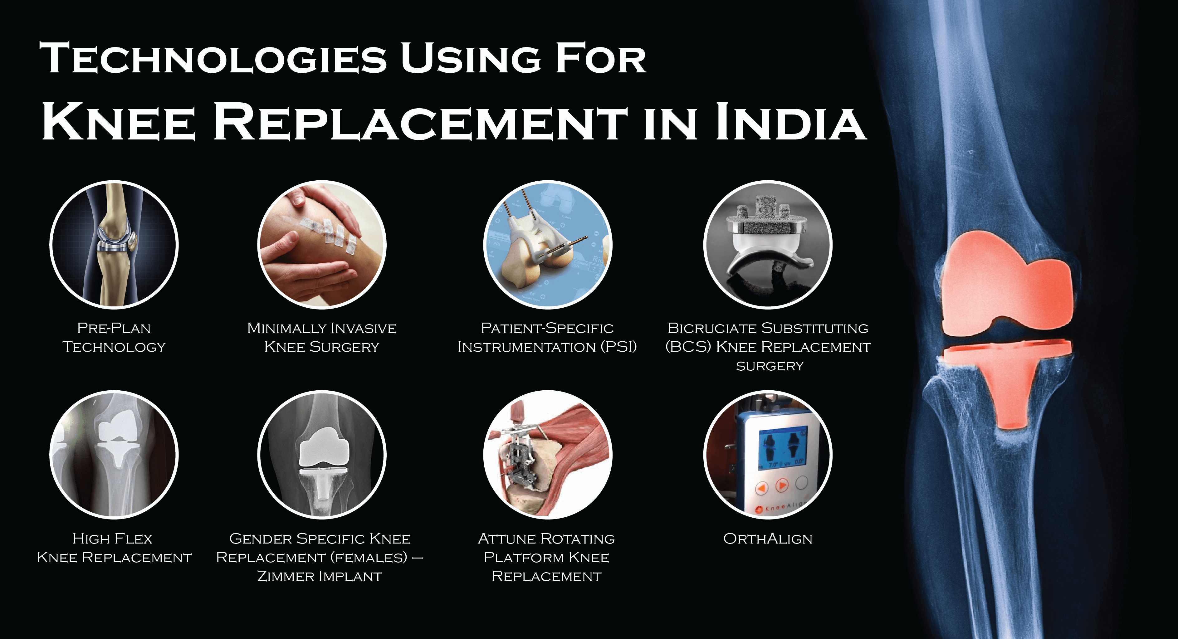 Knee Replacement Surgery In Hyderabad | India