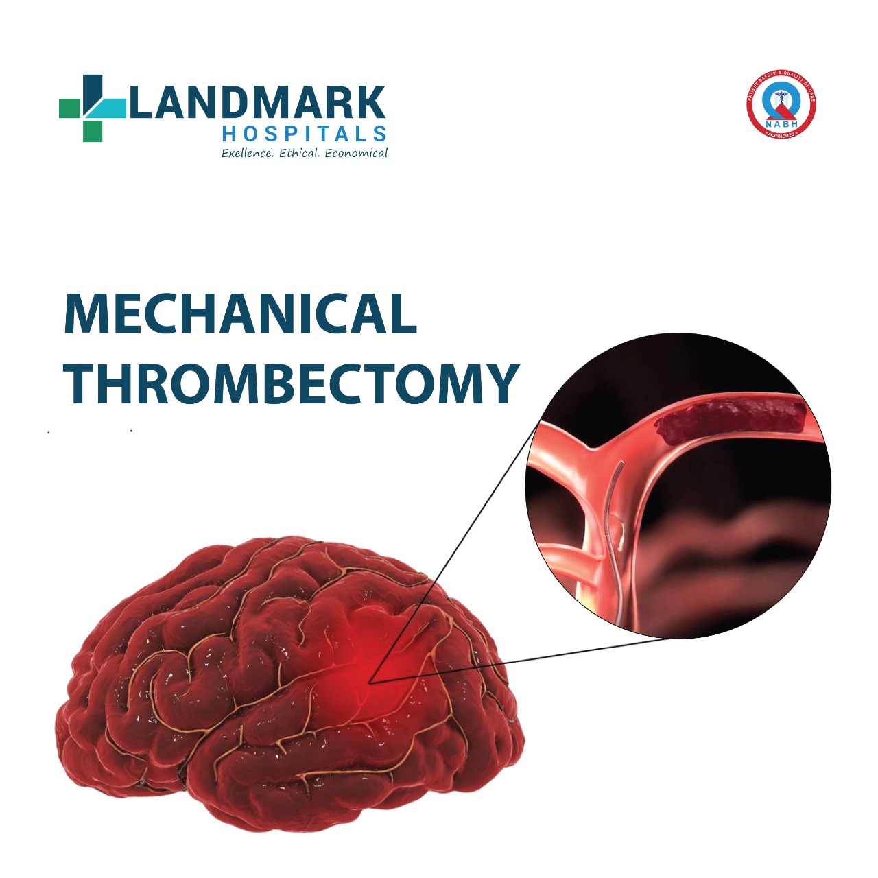 Mechanical thrombectomy explained
